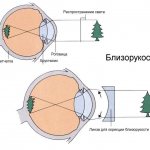 Plus vision is myopia or farsightedness
