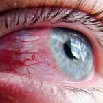 Покраснение глаз после спиртного - результат действия алкоголя на кровеносные сосуды