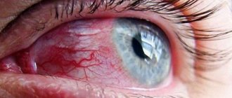 Покраснение глаз после спиртного - результат действия алкоголя на кровеносные сосуды