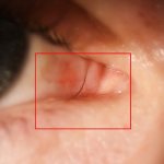 Redness of the eyes in a child. Causes and treatment for colds, ARVI, fever, allergies. Drops and folk remedies 