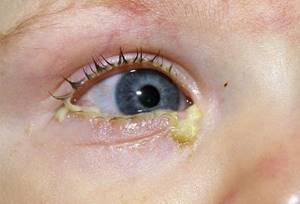 Покраснение глаз у ребенка. Причины и лечение при простуде, ОРВИ, температуре, аллергии. Капли и народные средства