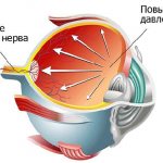 Повышенное внутриглазное давление