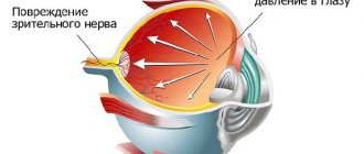 Increased intraocular pressure