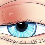 Causes of appearance and modern methods of treatment of various formations (bumps) on the eyelid