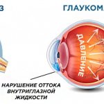 Glaucoma attack