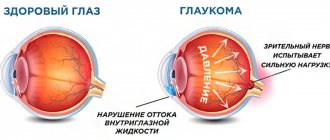 Приступ глаукомы