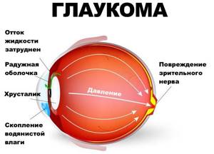 Признаки глаукомы