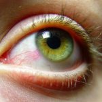 Раздражение глаза