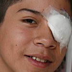 Child - surgical removal of chalazion