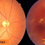 Сетчатка глаза - гипертоническая ретинопатия