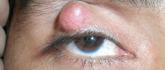 A lump on the eyebrow looks unpleasant and bothers the patient