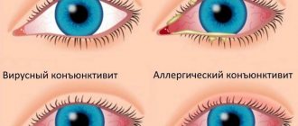 Symptoms and types of conjunctivitis