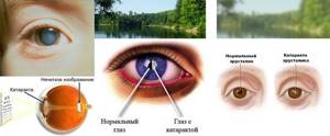 симптомы катаракты