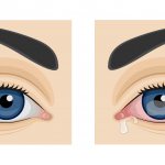 симптомы кератита