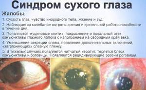 Синдром сухого глаза симптомы