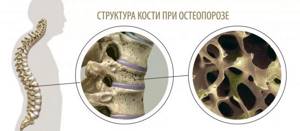 Системный остеопороз