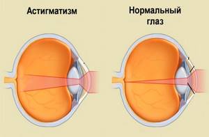 Список глазных капель при астигматизме у взрослых