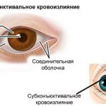 Subconjunctival hemorrhage