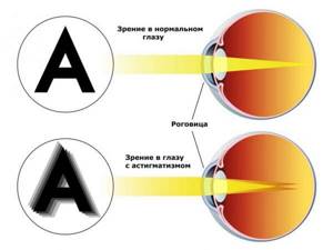 Существенное ухудшение зрения при гиперметропическом астигматизме