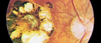 Токсоплазмозный хориоретинит