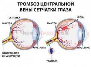 Тромбоз ЦВС глаза