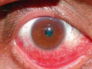 У ребёнка красные глаза: признаки патологии и основные терапевтические методы для снятия покраснения