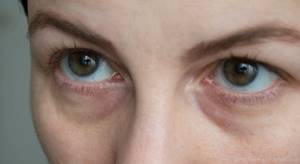 Убрать синяки под глазами: косметология, описание процедур, противопоказания, отзывы