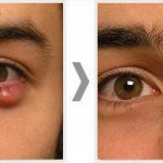 Удаление халязиона лазером