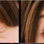 Removing bags under the eyes