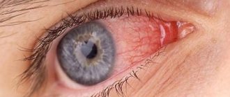 Удаление пингвекулы лазером. Лечение пингвекулы глаза глаза | FedorovMedCenter.ru