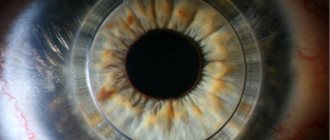 Installation of intrastromal segments (rings) for keratoconus