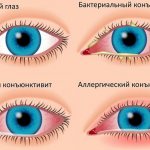 Виды и симптомы конъюнктивита