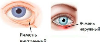 Internal and external styes