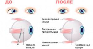 Воспаление глаза после операции по косоглазию