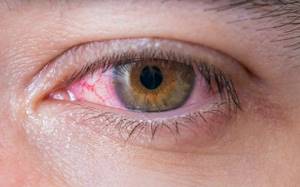 воспаление конъюнктивы — слизистой оболочки глаза