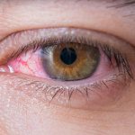 воспаление конъюнктивы — слизистой оболочки глаза