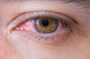 Воспаление оболочки глаза