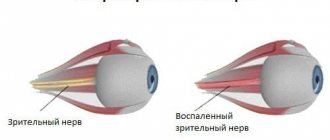 воспаление зрительного нерва