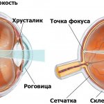 Врожденная дальнозоркость — физиологическое явление, которое связано с размером глазного яблока ребенка
