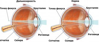Congenital farsightedness is a physiological phenomenon that is associated with the size of the child’s eyeball