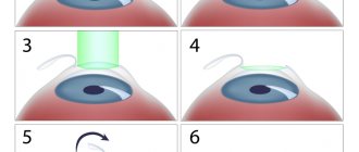 All types of Lasik - differences, advantages and disadvantages
