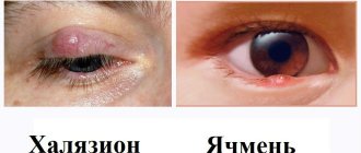 Stye and chalazion
