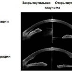 Закрытоугольная и открытоугольная формы глаукомы