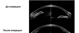 Closed-angle and open-angle forms of glaucoma