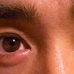 Заразен ли ячмень