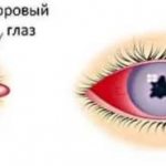 Здоровый глаз и глаз с увеитом