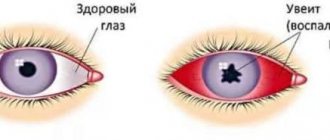 Здоровый глаз и глаз с увеитом