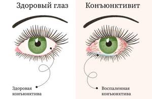 Здоровый глаз и конъюнктивит