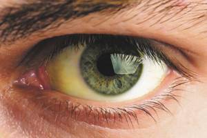 желтизна глазной склеры
