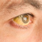Желтые склеры глаз причины